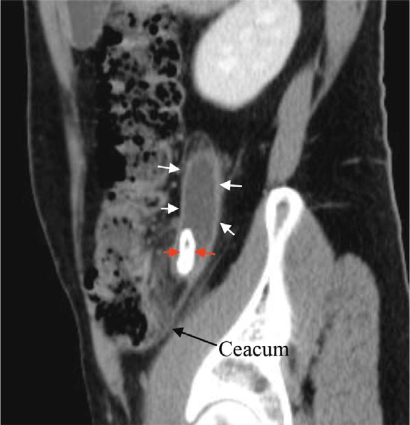Practical Points In Diagnosis Of Acute Appendicitis By Ct Image Andor