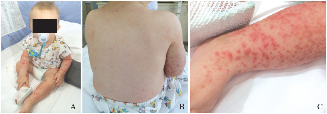 Gianotti-Crosti Syndrome Related to Varicella Infection: A Case Report