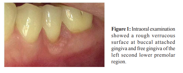 squamous papilloma on gingiva